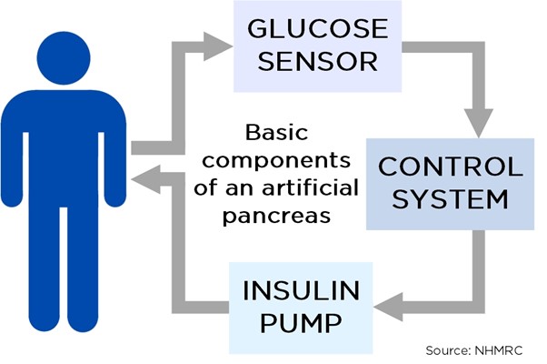 Diagram depicting the three basic components of an artificial pancreas. The loop starts with the glucose sensor, that feeds data to the control system, that then drives the insulin pump to deliver insulin.
