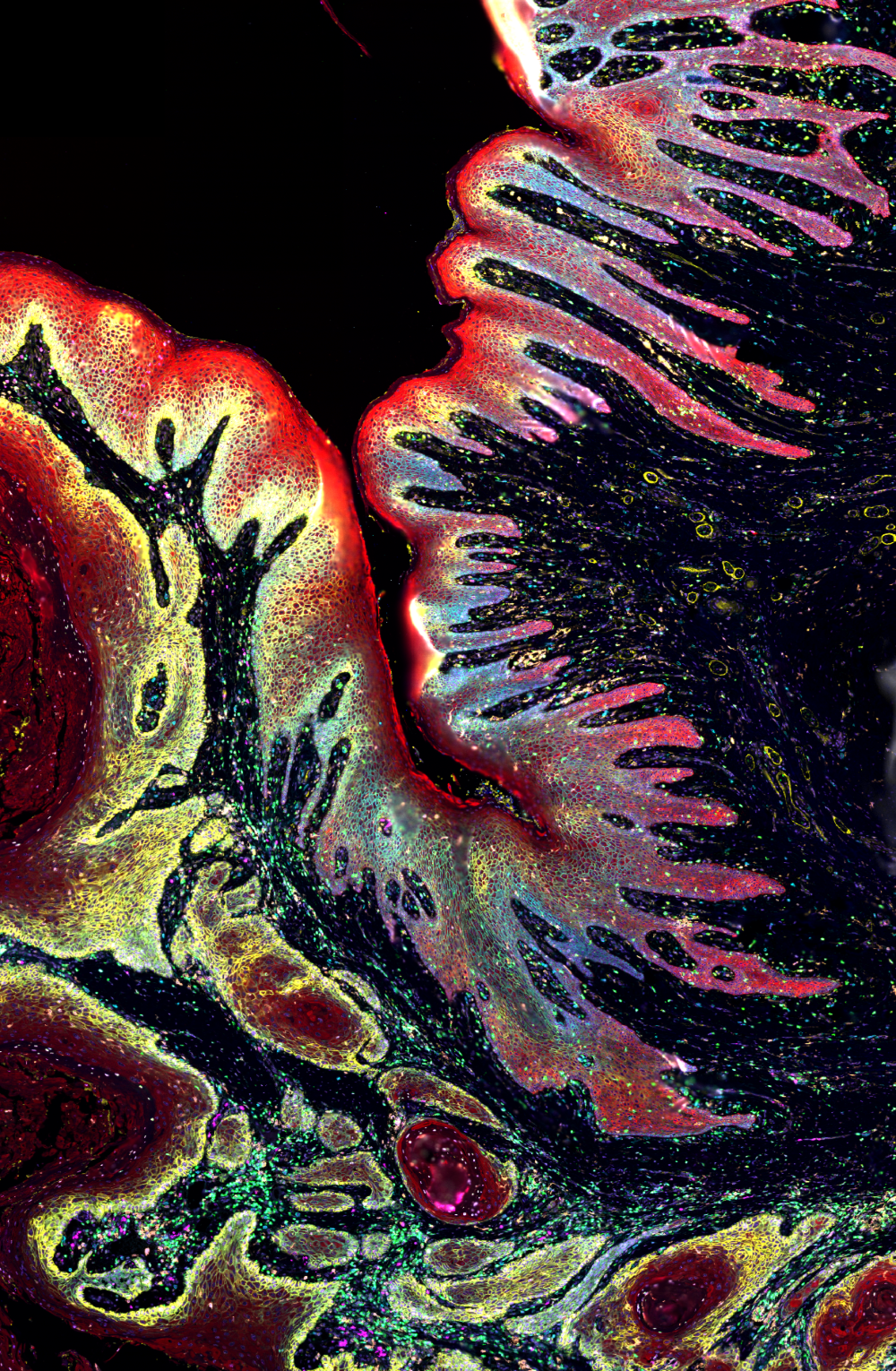 Digital image of skin cancer. Description under image.