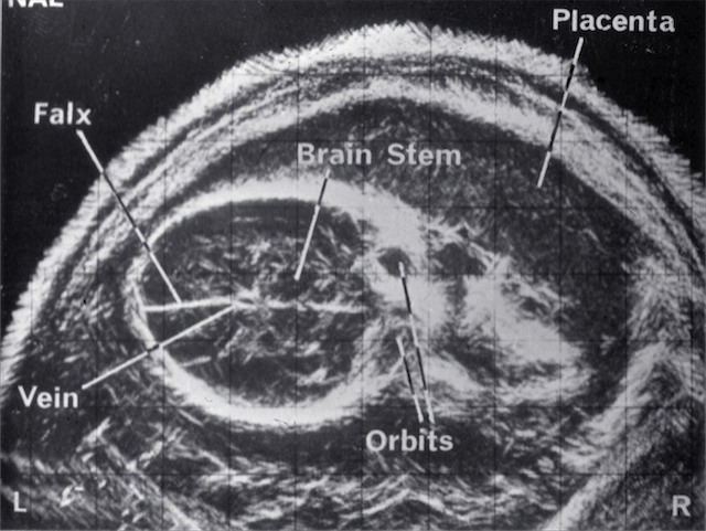 "Early black and white obstetric ultrasound. Source ASUM"