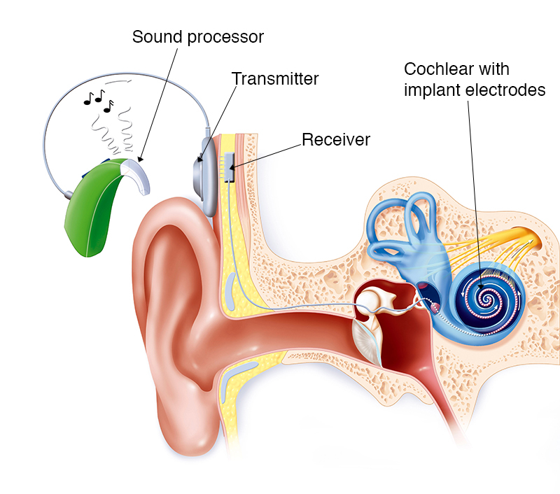 Illustrated components of the cochlear implant system