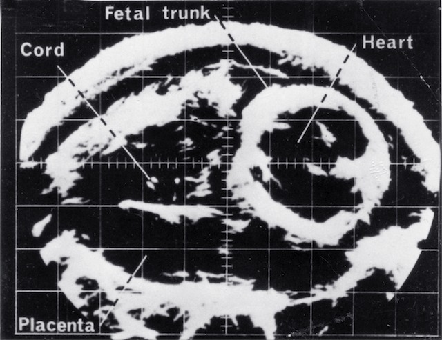 "Early black and white obstetric ultrasound. Source ASUM"